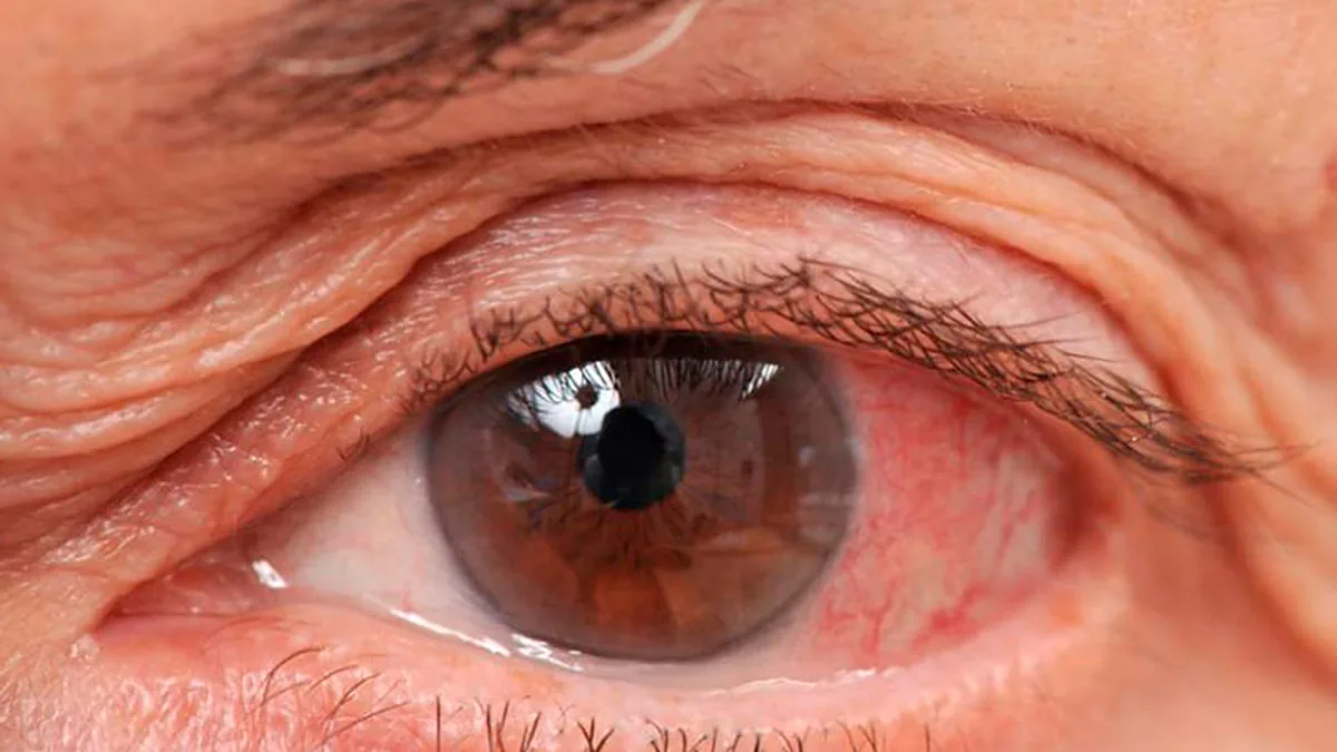 Primer plano de un ojo enrojecido e irritado